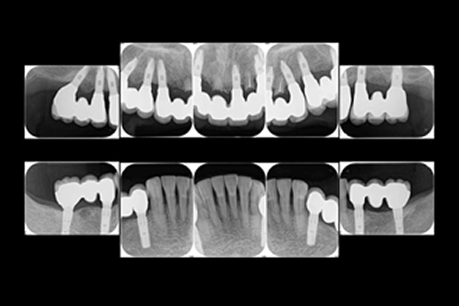 インプラントによる治療例