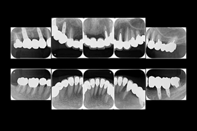 インプラントによる治療例