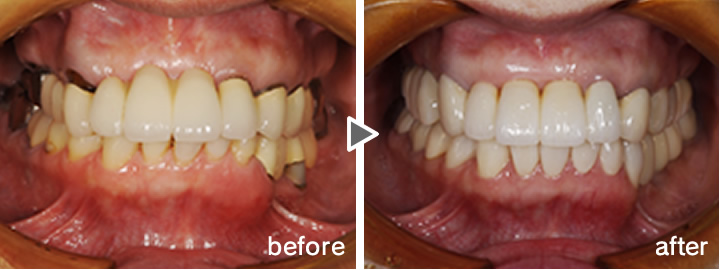 インプラントによる治療例