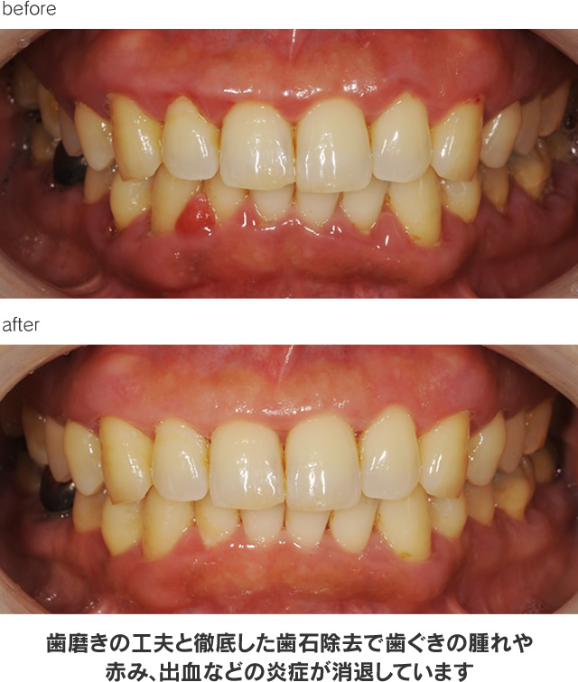 歯周病治療による治療例